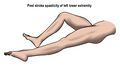 Extensor spasticity pattern of the lower extremity