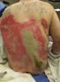 Example of wound after infection has set in