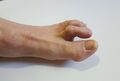 Hammer toe