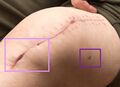 Incision line after staples have been removed. The light purple box shows two areas of incision line dehiscence, and the dark purple box shows the location of a post-surgical drain.