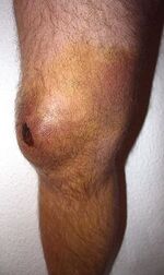 bursa in shoulder