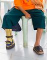 Leprosy-related amputations on multiple limbs