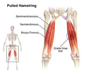 Image of grade 3 hamstring tear