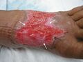 Arrows note areas of advancing epithelial cells along sloped wound edges.