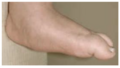 Flat foot