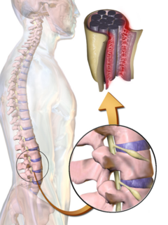 Arachnoiditis