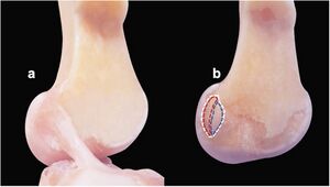 Attachment site of the ACL on the femur