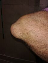 Image showing olecranon bursitis