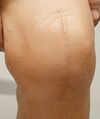 Healed incision line after knee arthroplasty surgery.