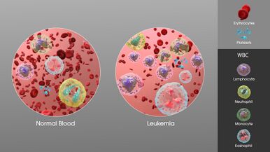3D Medical Animation still showing an increase in white blood cells of a person suffering from Leukemia.