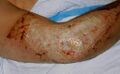 Deep partial burn wound