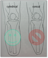 Cylindrical stump (fibula 5-10 mm shorter)