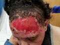 Deep partial burn wound