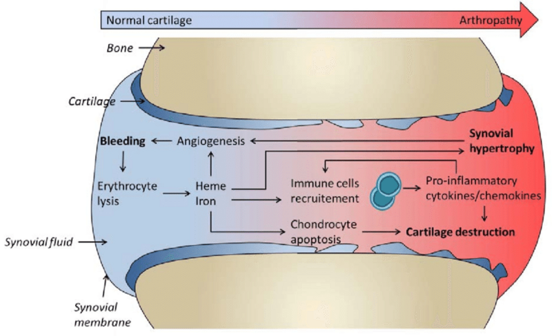 File:Physiopathology-of-hemophilic-arthropathy.png