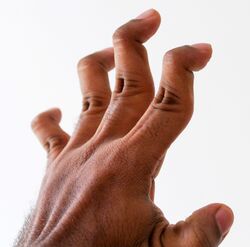 Swan neck deformity
