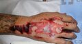 Example of wound prior to desiccation