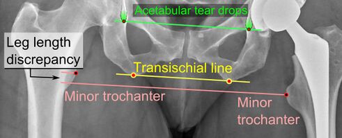 Leg length discrepancy after Total Hip Replacement