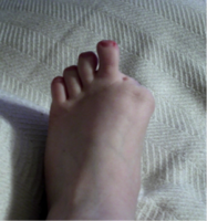 Great toe amputation