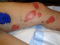 Superficial partial burn wound