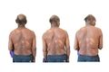 Skin lesions on the back of a patient with leprosy