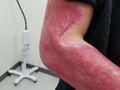 Resulting scars of a full thickness burn wound