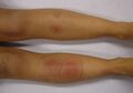 Areas of erythema
