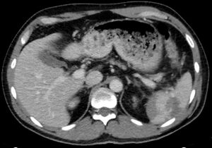 CT Ruptured spleen