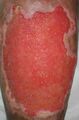Healthy beefy granulation tissue.