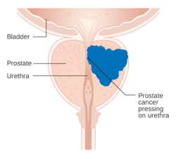 Diagram demonstrating how prostate cancer can cause urinary issues