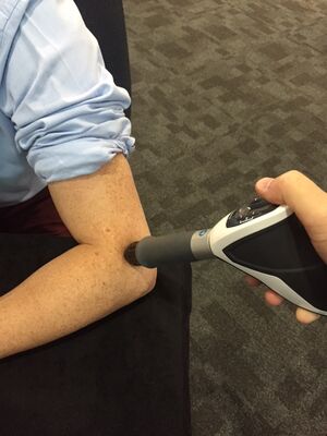 Extracorporeal Shockwave Therapy for Lateral Epicondyle Tendinopathy.