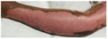Red and pink areas demonstrate re-epithelialisation.