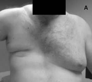 Photograph of adult torso with absence of right breast and right pectoralis major muscles in Poland syndrome.