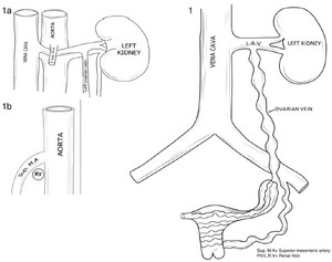 1 illustrates a distended ovarian vein, and 1A and 1B depicts potential compression of the renal vein.