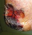 Red arrow points to calcified blood vessels. Image used with kind permission of Dana Palmer PT.
