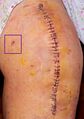 Post-surgical incision line with staples in place. The dark purple box shows the location of a post-surgical drain that has been removed.