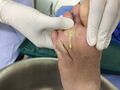 Purulent drainage