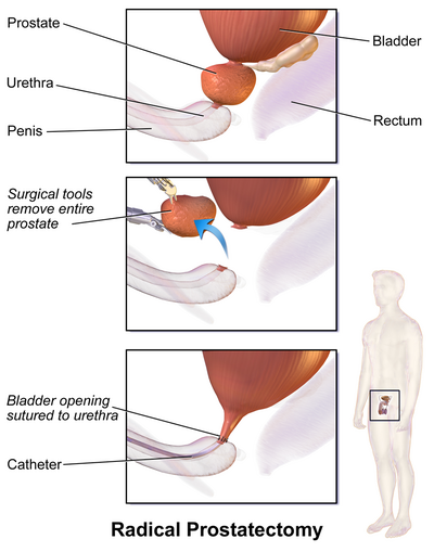 Radical Prostatectomy