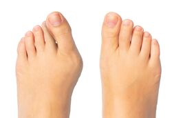 Hallux valgus