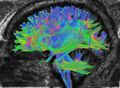 Example of Diffusion Tensor Imaging