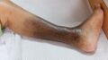 Haemosiderin staining